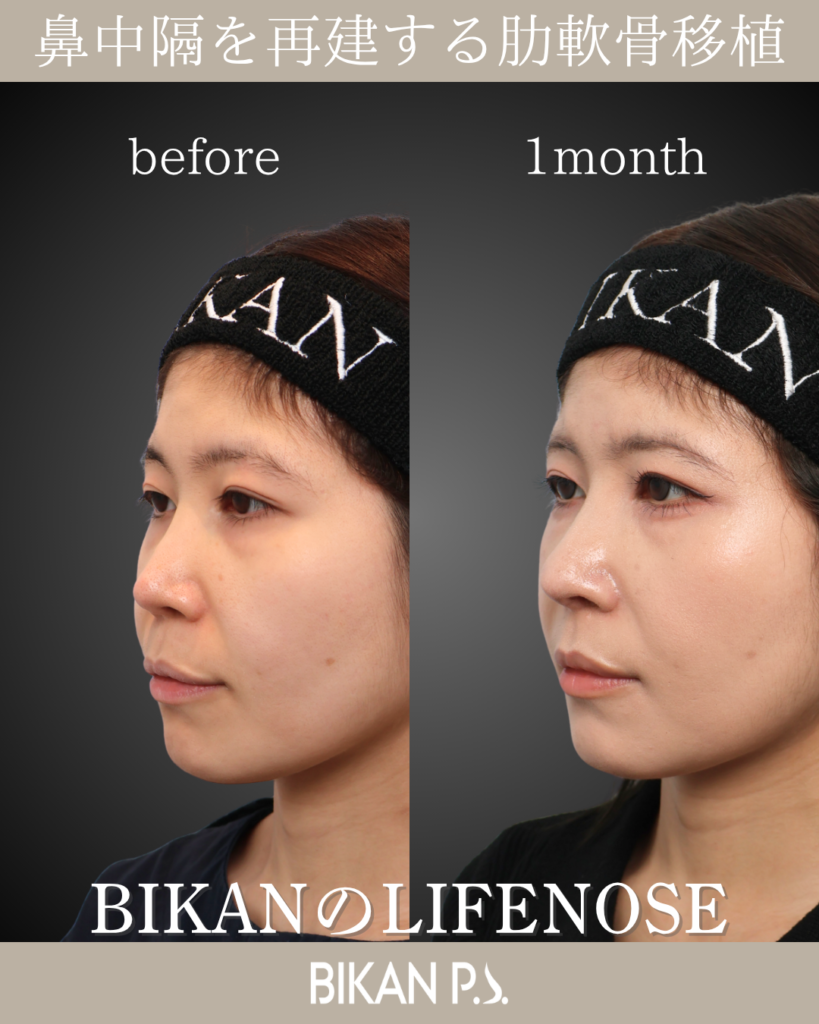 他院修正鼻整形症例 術前・術後1ヶ月 斜め BIKAN CLINIC