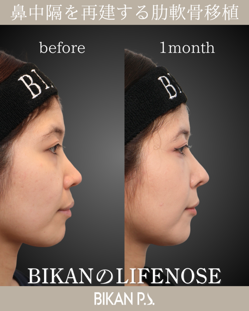 他院修正鼻整形症例 術前・術後1ヶ月 側面 BIKAN CLINIC