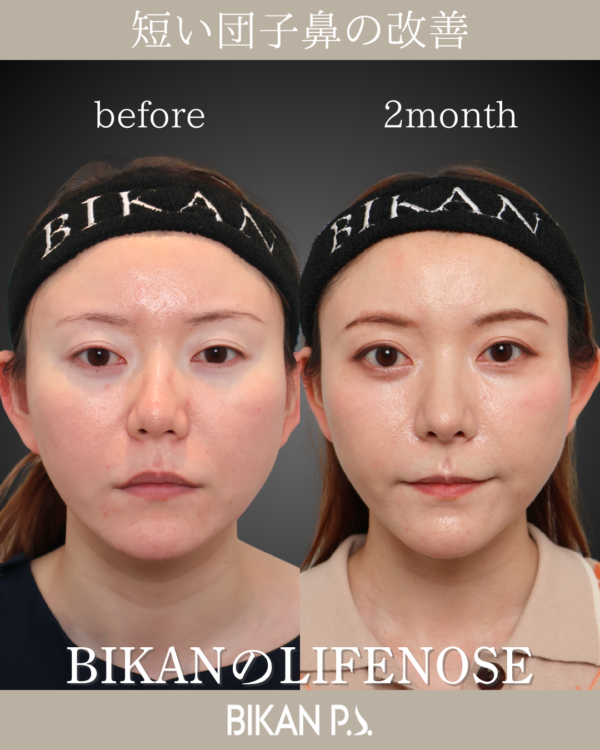 短い鼻・団子鼻を改善した鼻整形｜肋軟骨を用いたLIFE NOSE症例【術後2ヶ月】