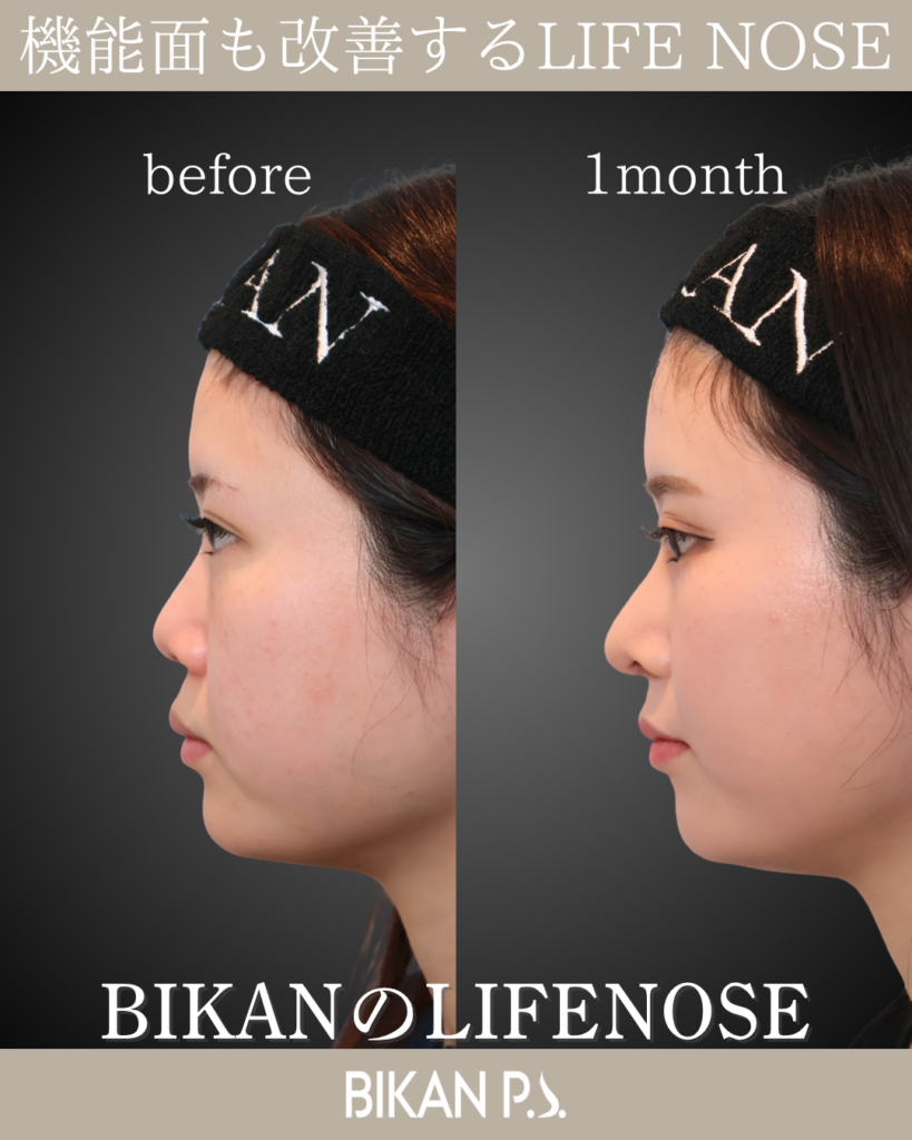 団子鼻と短い鼻に対して鼻中隔延長とLIFE NOSE 鼻先 自家肋軟骨移植を行った術後1ヶ月症例