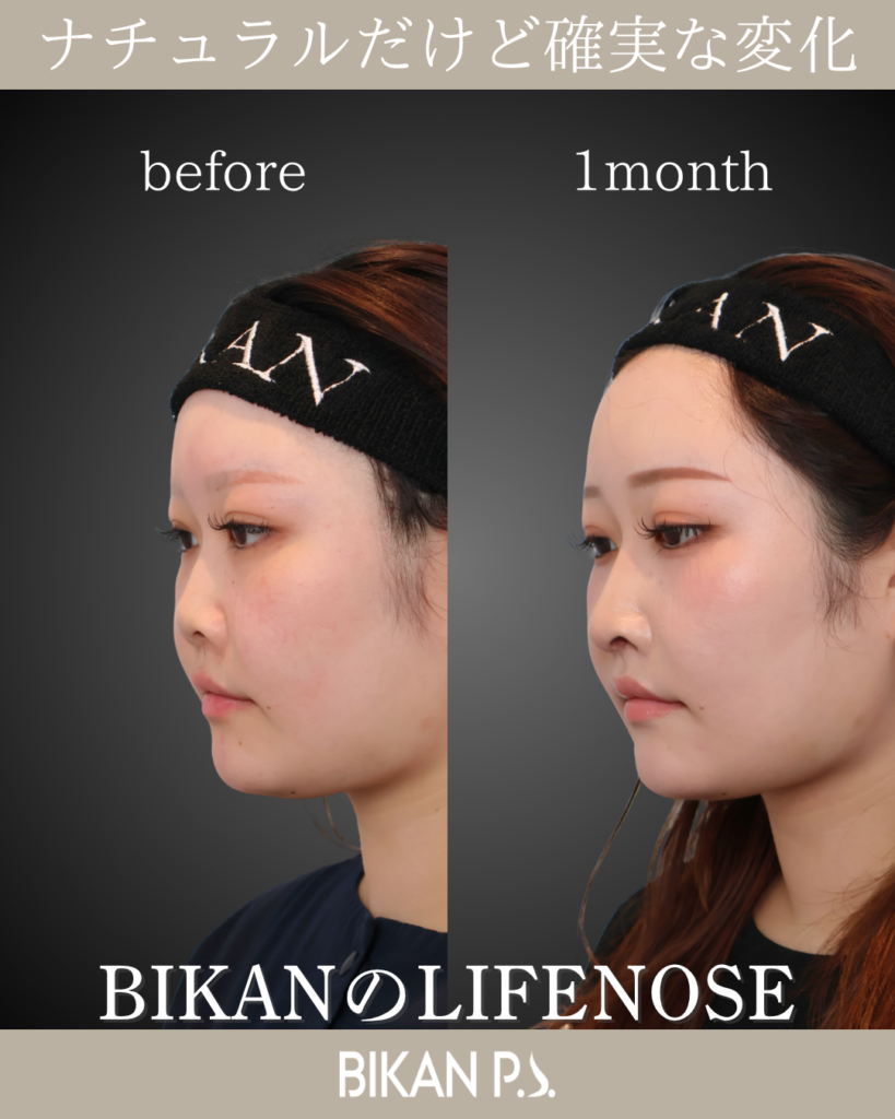 LIFE NOSEと貴族手術で中顔面と鼻に自然な立体感を形成した術前と術後1カ月の斜め比較｜BIKAN