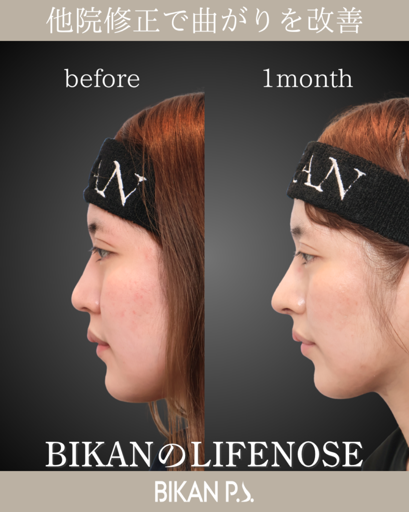 鼻筋から鼻先までのラインが滑らかになり、Eラインとの調和も向上。