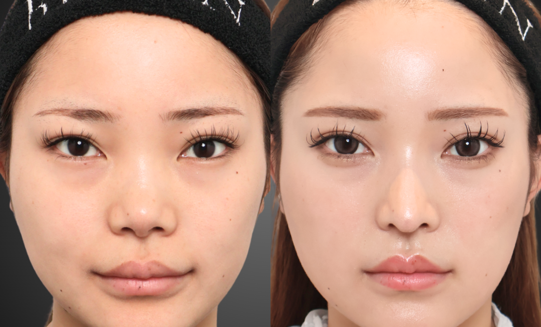 他院修正鼻整形 LIFE NOSE 鼻筋と鼻先の全体自家肋軟骨移植 術前・術後2ヶ月 正面