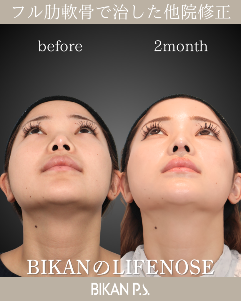 他院修正鼻整形 LIFE NOSE 鼻筋と鼻先の全体自家肋軟骨移植 術前・術後2ヶ月 鼻孔