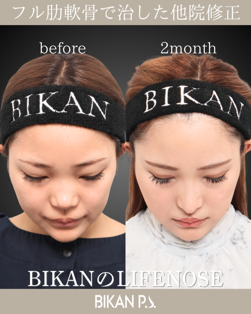 他院修正鼻整形 LIFE NOSE 鼻筋と鼻先の全体自家肋軟骨移植 術前・術後2ヶ月 上面
