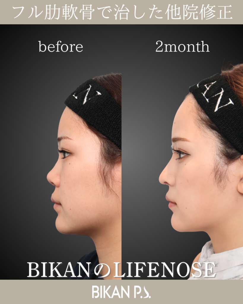 他院修正鼻整形 LIFE NOSE 鼻筋と鼻先の全体自家肋軟骨移植 術前・術後2ヶ月 側面