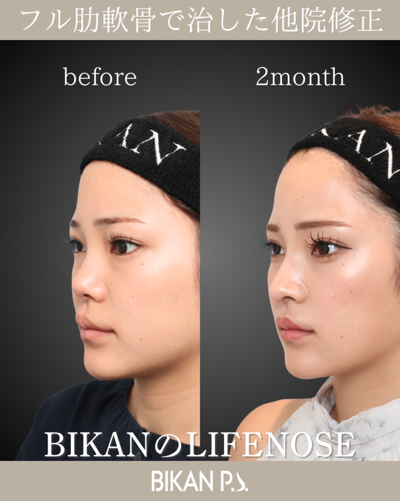 他院修正鼻整形 LIFE NOSE 鼻筋と鼻先の全体自家肋軟骨移植 術前・術後2ヶ月 斜め