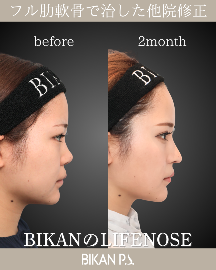 他院修正鼻整形 LIFE NOSE 鼻筋と鼻先の全体自家肋軟骨移植 術前・術後2ヶ月 側面