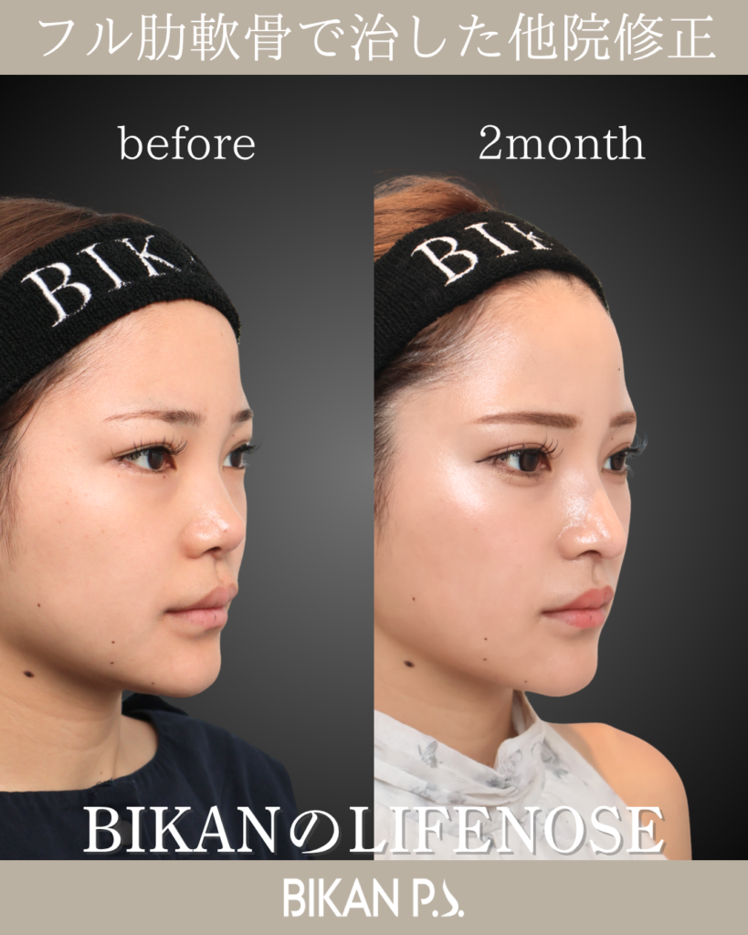 他院修正鼻整形 LIFE NOSE 鼻筋と鼻先の全体自家肋軟骨移植 術前・術後2ヶ月 斜め