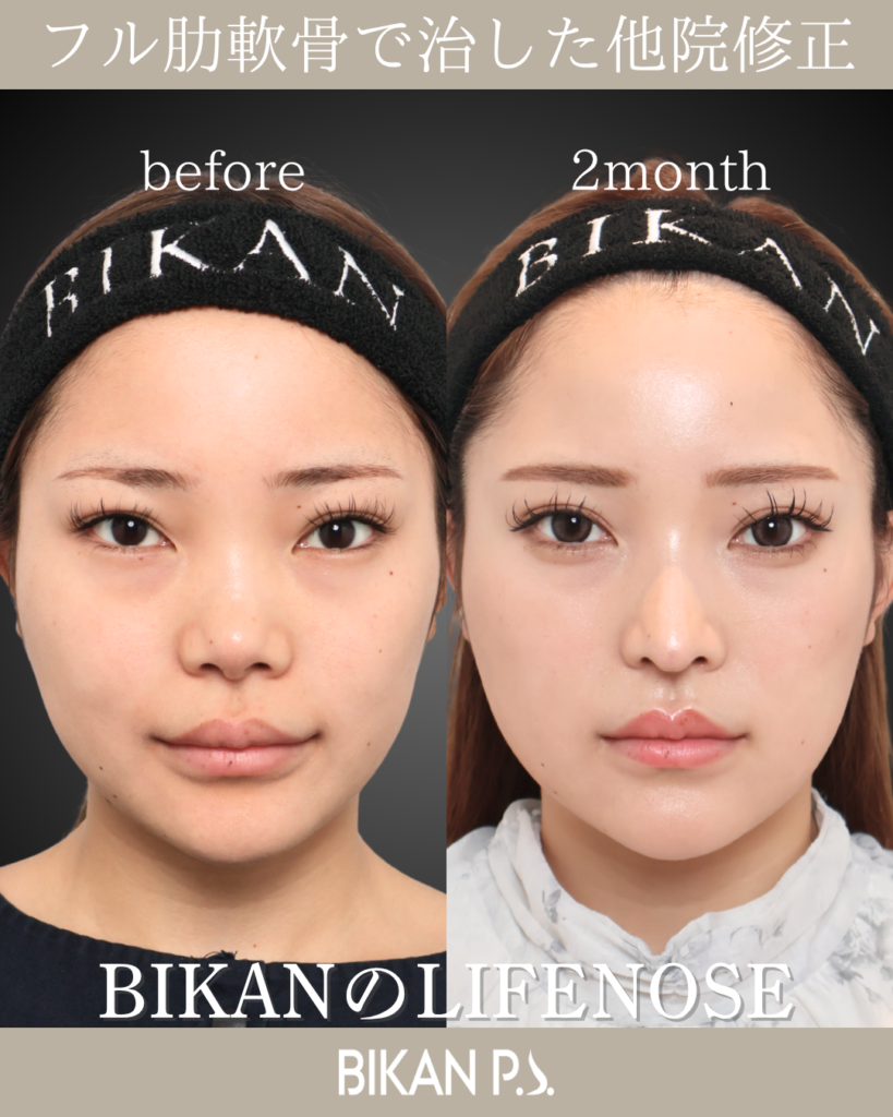 他院修正鼻整形 LIFE NOSE 鼻筋と鼻先の全体自家肋軟骨移植 術前・術後2ヶ月 正面