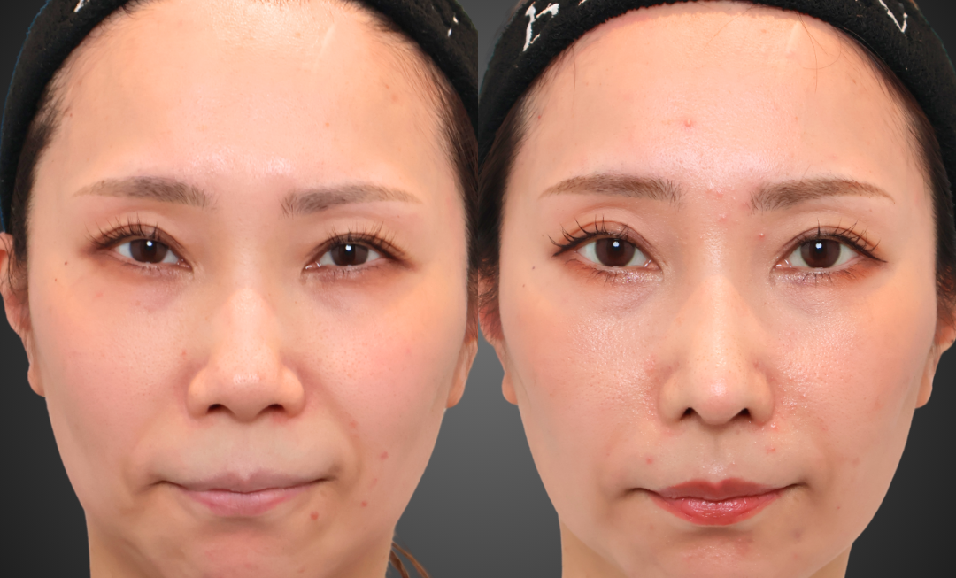 中顔面の立体感とほうれい線を改善した鼻整形術後1ヶ月の症例