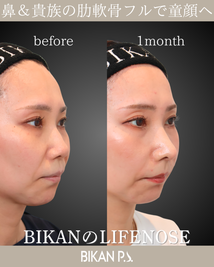 鼻中隔延長とLIFE NOSE 鼻筋と鼻先の全体自家肋軟骨移植による術後1ヶ月の症例