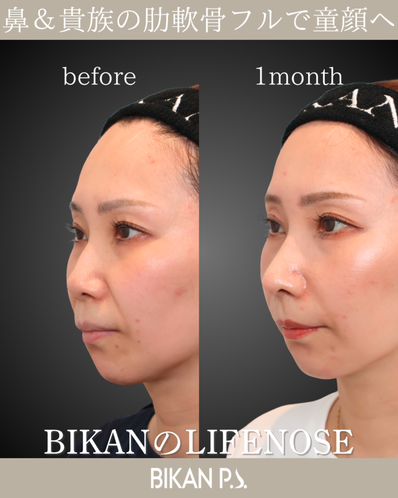 鼻中隔延長とLIFE NOSE 鼻筋と鼻先の全体自家肋軟骨移植による術後1ヶ月の症例