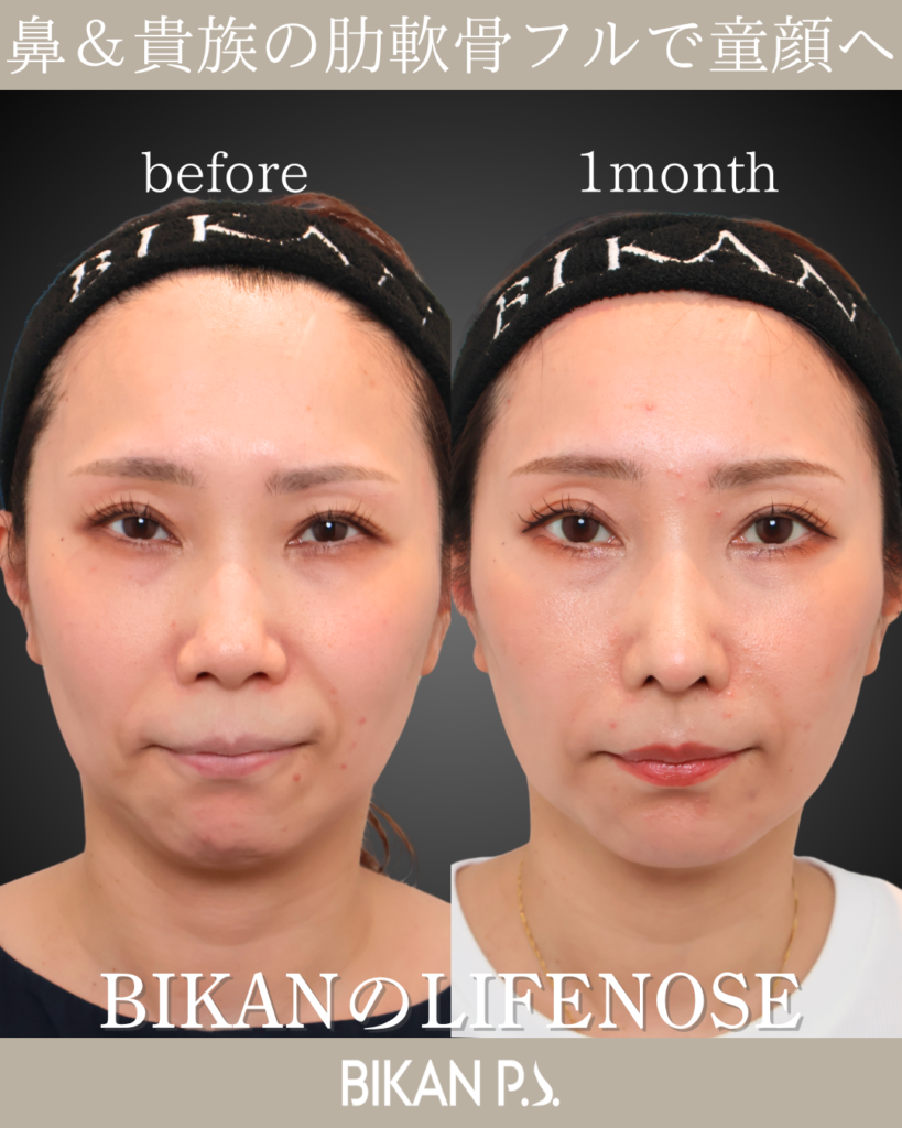 中顔面の立体感とほうれい線を改善した鼻整形術後1ヶ月の症例